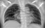 la semiologie de l'imagerie medicale - I.4.1 syndrome alvéolaire
