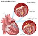 a <b>prolapsed mitral valve</b>
