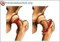 Tipos de <b>fractura de fémur</b>: