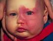 A <b>port wine stain</b> is a