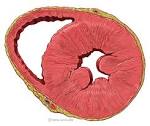 Ventricular <b>Hypertrophy</b>