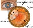 <b>Detached Retina</b> - AllAboutVision.
