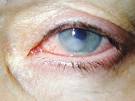 <b>Queratitis por Acanthamoeba</b>