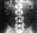 File:<b>Nephrocalcinosis</b>.jpg