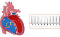 <b>Tachycardia</b>