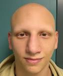 <b>Alopecia</b> Totalis