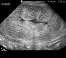 <b>Autosomal recessive polycystic</b>