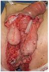 <b>Gangrena de Fournier</b>:
