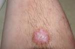 Clear cell <b>acanthoma</b> in