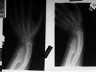 Cartilaginous <b>Exostoses</b>