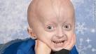 <b>Progeria</b>, seen in this boy,