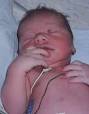 <b>Cyanosis</b> - Wikipedia, the free