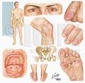 Is Chlamydia Curable by Antibiotics? | <b>Sexually Transmitted</b>