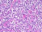 ALK Anaplastic <b>Large cell</b>