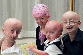Medicina: Progeria, Envejez prematura  Images?q=tbn:ANd9GcTxTiz6MAb1VdLkJlhofFiWg2I3s4YZTQafTlq4DBJEO76CAQYnGc8zVQb5