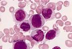 <b>acute monocytic leukemia</b>.