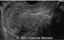 Ectopic <b>pregnancy</b>, <b>tubal</b>, live