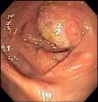 American Journal of Gastroenterology - Clinical Vignettes - Colon