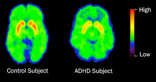 Not Correlated with ADHD