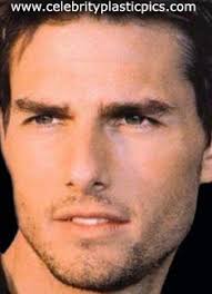 his rhinoplasty photo