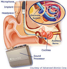 cochlear implant device