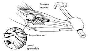 Learn more about tennis elbow