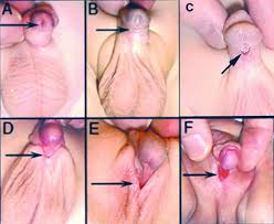 the genital swellings.