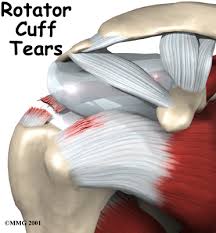 Rotator Cuff Tears