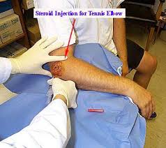 Tennis Elbow Injection.