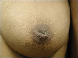 Example of Inverted Nipples in
