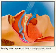 signs of snore sleep apnea