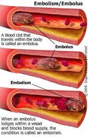 Embolism: occurs when foreign