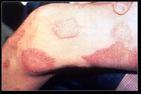 Leprosy Treatment,Leprosy