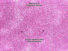 about Lymphoma Non Hodgkin