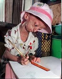 genetic disorder progeria,