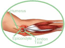 Help for Treating Tennis Elbow