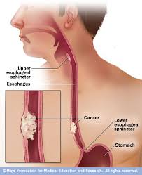 Esophageal cancer