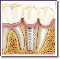 implantes dentales Importancia del mantenimiento de los implantes