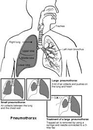 What is a pneumothorax?