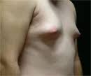 مشكلة تضخم الثدي عند الرجال GYNECOMASTIA Gynecomastia