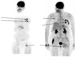 NonHodgkins Lymphoma PET scan