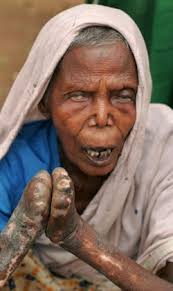 Understanding Leprosy