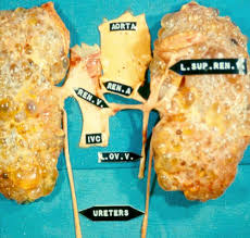 (31) Polycystic kidney