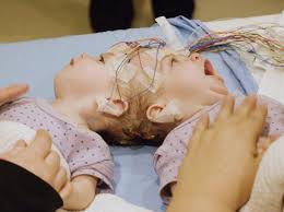 Conjoined twins in Canada