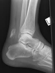 avulsion fracture of the