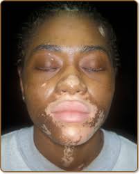 Learn more about Vitiligo Part