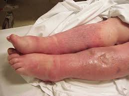 Pictures of Sepsis