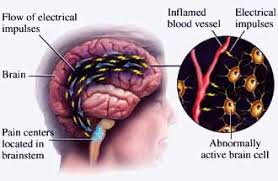 Migraine affects more than 28