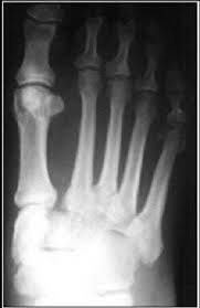 Lisfranc injury of right foot