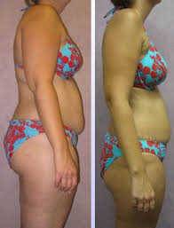 weight from HCG diet. Wow.